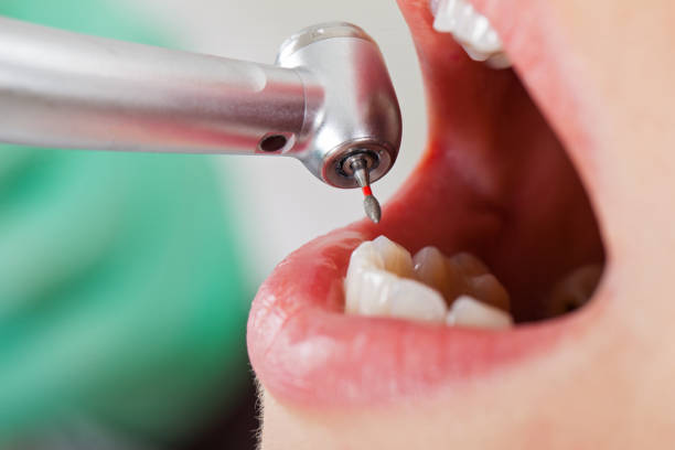 Best Emergency Root Canal Treatment in Hoffman Estates, IL
